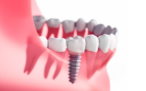 インプラントの模型